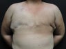 Flap-based breast reconstruction - DIEP