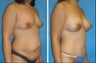Cleveland Mommy Makeover