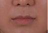 Smile Lipt, another name for mouth corner lift