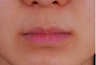 Smile Lipt, another name for mouth corner lift