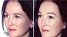 Young Female Treated for Brow Ptosis and Crow's Feet