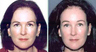 Young Female Treated for Brow Ptosis and Crow's Feet