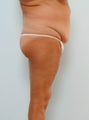 Body Lift