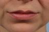 Removal of lip nevus