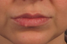 Removal of lip nevus