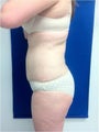 Laser Liposuction
