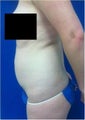 Laser Liposuction