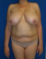 Tummy Tuck and Breast Lift