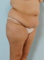 Body Lift
