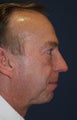 Male with Chin Implant