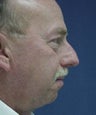 Male with Chin Implant