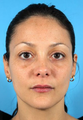 Botox and Fillers (Restylane and Juvederm)