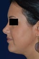 36 Year Old Female Treated for Heaviness in the Neck