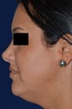 36 Year Old Female Treated for Heaviness in the Neck