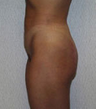 Liposuction (lateral thighs and abdomen)