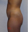 Liposuction (lateral thighs and abdomen)