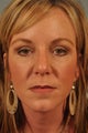 Eyelid Surgery