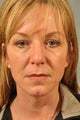 Eyelid Surgery