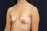 Breast Augmentation