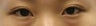 Bilateral Asian Eyelid Surgery