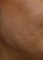 Acne Scar Treatment