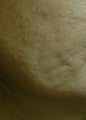 Acne Scar Treatment