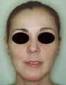 Female patient who underwent nose surgery