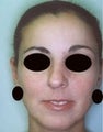 Female patient who underwent nose surgery
