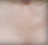 Sunspot Treatment