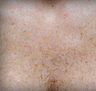 Sunspot Treatment