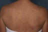 Female treated for Sunspots/Photoaging