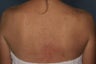 Female treated for Sunspots/Photoaging