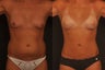 fat transfer breast enhancement