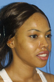 Ethnic Rhinoplasty