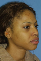 Ethnic Rhinoplasty
