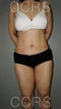 VASER lipo with mini TT - 45 yrs. old female