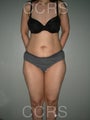 VASER lipo with mini TT - 45 yrs. old female
