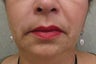 Juvederm