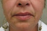 Juvederm