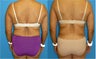 56 y.o. Female underwent Liposuction + Fat Transfer to buttocks