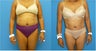 56 y.o. Female underwent Liposuction + Fat Transfer to buttocks