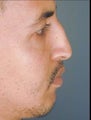 Male Middle Eastern Rhinoplasty