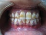 Laser Speed Tooth Whitening