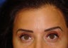 Forehead Lines
