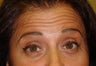 Forehead Lines