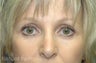 Tired Eyes Corrected with Blepharoplasty