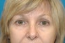 Tired Eyes Corrected with Blepharoplasty