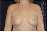 Breast Lift