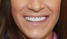 35 year old female treated with All-on-4 DentalImplant Procedure