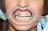 35 year old female treated with All-on-4 DentalImplant Procedure
